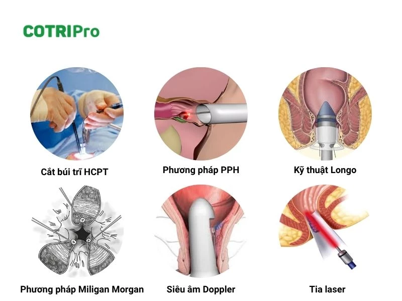 Phương pháp phẫu thuật làm co búi trĩ