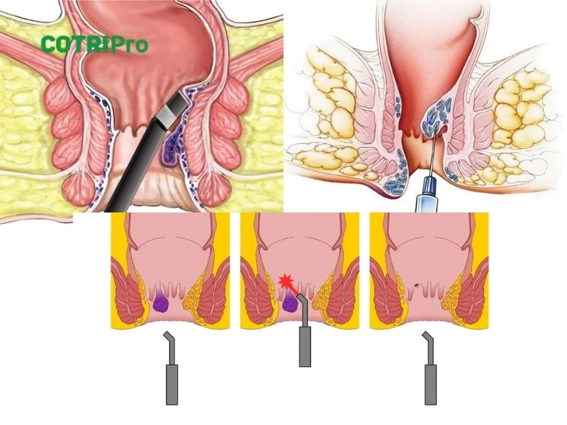 Thủ thuật y tế chữa trĩ mà không phẫu thuật