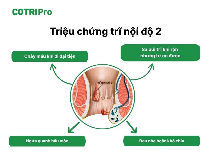 Nhận biết triệu chứng trĩ độ 2 đề phòng ngừa