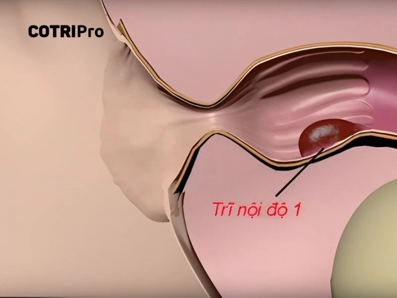 Trĩ nội độ 1 là giai đoạn đầu của bệnh