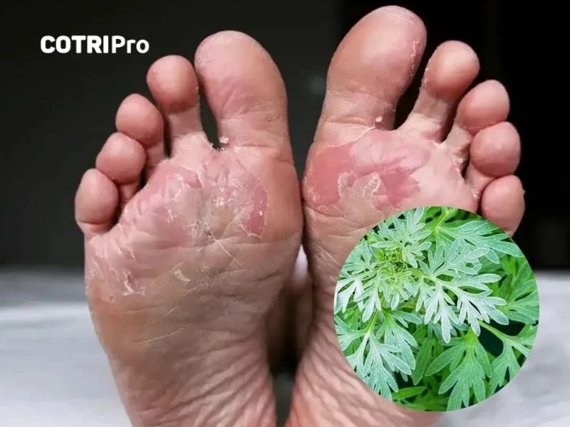 Ngải cứu trị nấm da mồ hôi chân