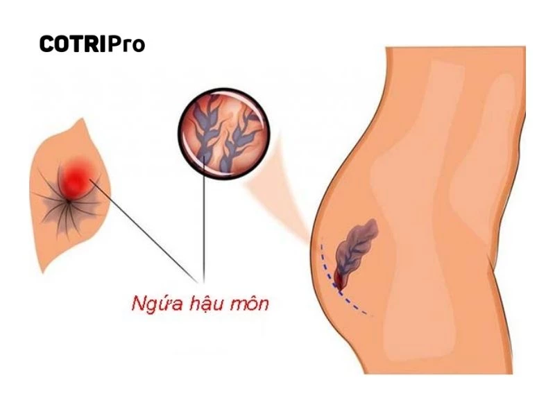 Trĩ gây ngứa hậu môn nguyên nhân nào