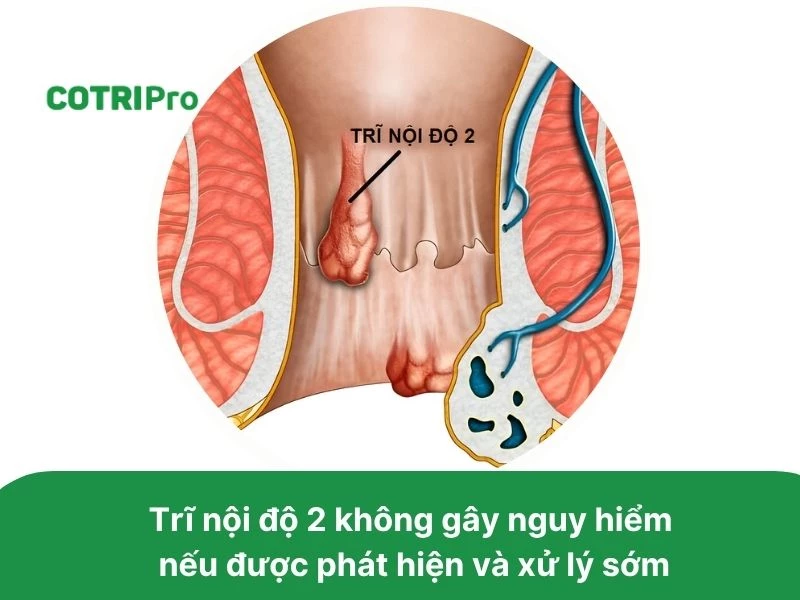 Bệnh trĩ nội độ 2 không gây nguy hiểm