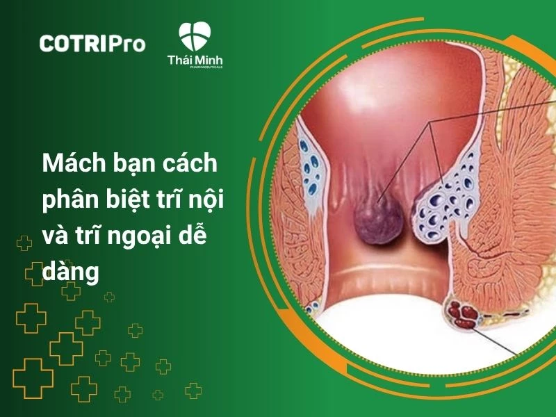 Mách bạn cách phân biệt trĩ nội và trĩ ngoại dễ dàng