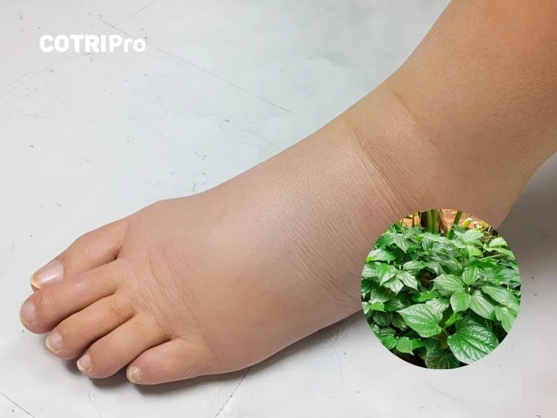 Lá lốt trị phù thũng suy thận
