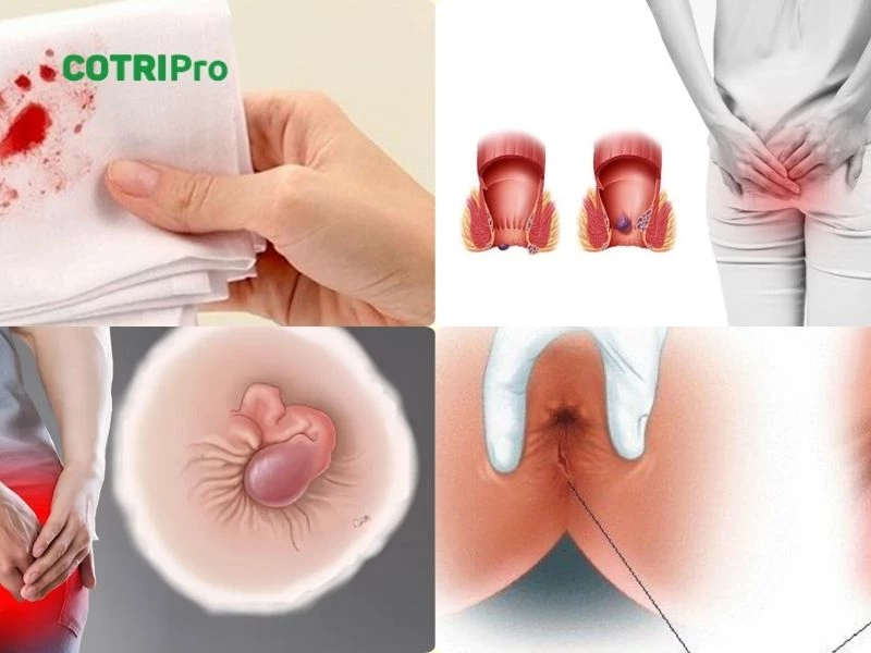 Bệnh trĩ sau sinh không gây nguy hiểm