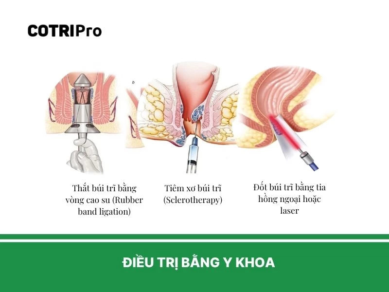 Biện pháp điều trị trĩ gây ngứa hậu môn