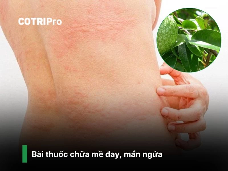 Chữa nổi mề đay, mẩn ngứa với cây bình bát