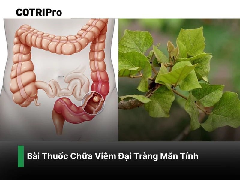 Chữa viêm đại tràng mãn tính với cây vông