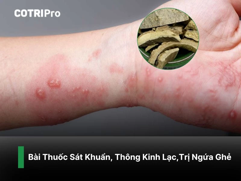 Bài thuốc sát khuẩn, trị ghẻ từ cây vông