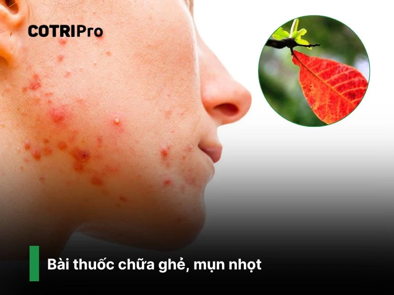 Chữa mụn nhọt với lá bàng