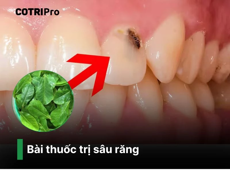Chữa sâu răng với lá bàng