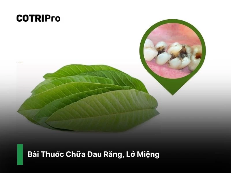 Chữa đau răng, lở miệng với lá ổi