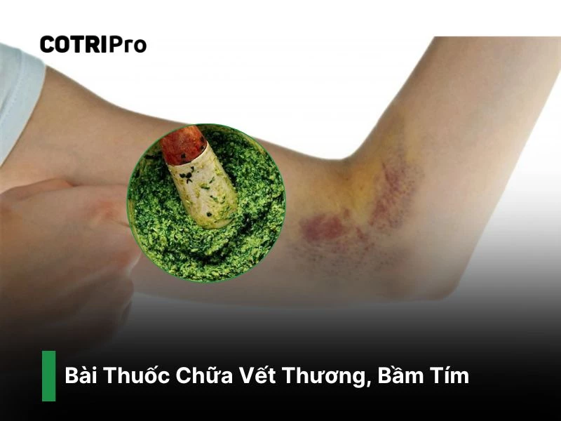 Chữa bầm tím vết thương bằng đắp lá ổi