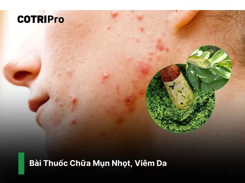 Chữa mụn nhọt viêm da với lá ổi