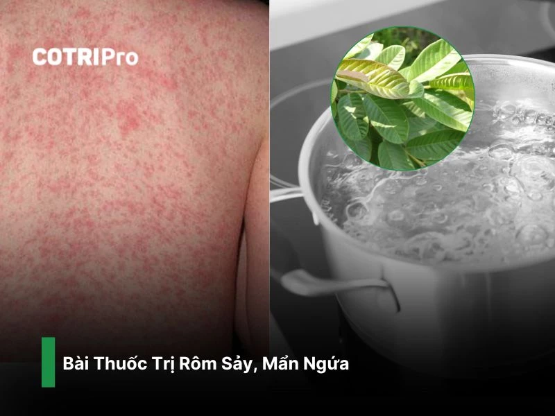 Trị rôm sảy, mẩn ngứa với lá ổi