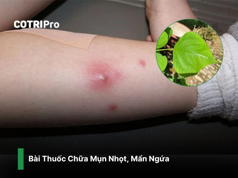 Điều trị mụn nhọt với lá vông
