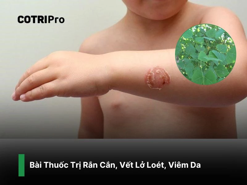 Trị viêm, lở loét da với lá vông