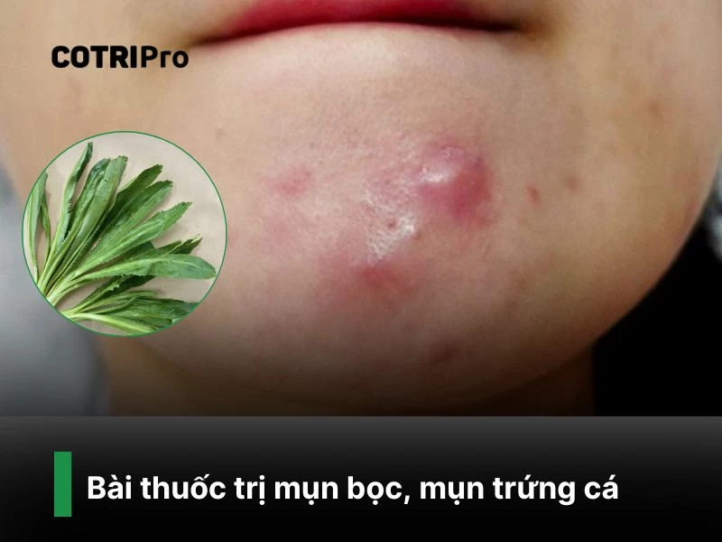 Uống nước cốt ngò gai giúp trị mụn bọc