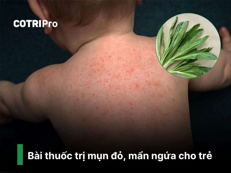 Trị mụn đỏ ở trẻ em với ngò gai
