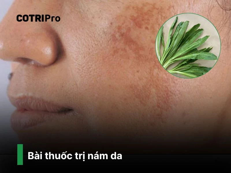 Bài thuốc trị nám da với ngò gai