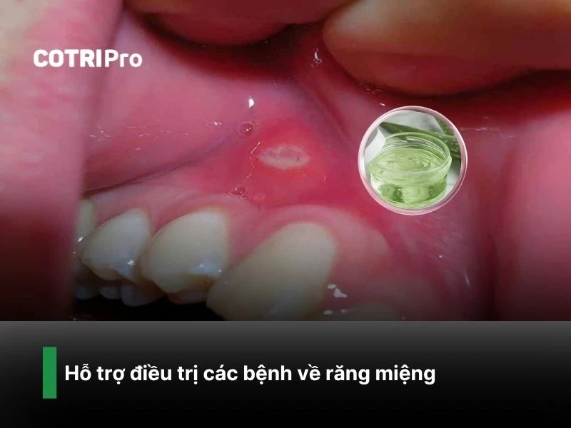 Điều trị bệnh răng miệng với nha đam