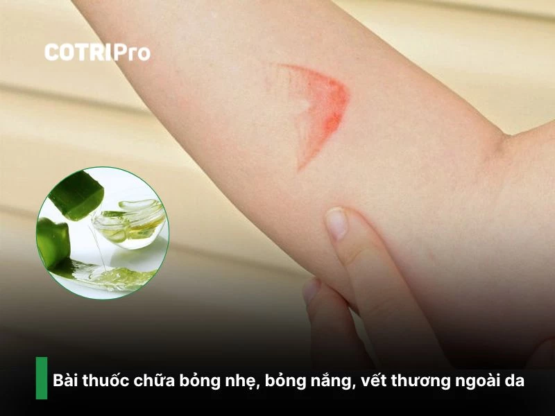 Thoa nha đam chữa bỏng vết thương