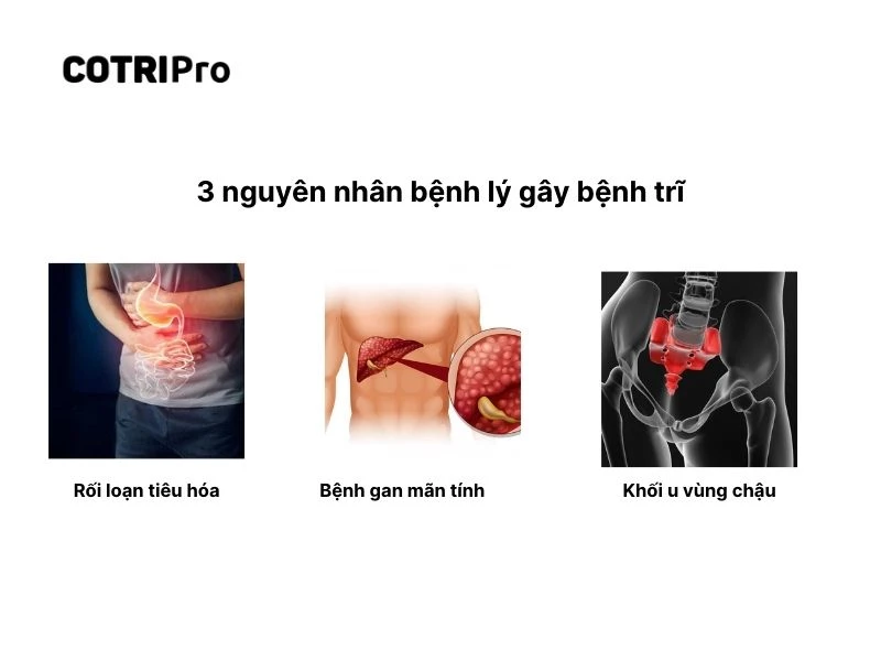 Nguyên nhân bệnh lý gây trĩ