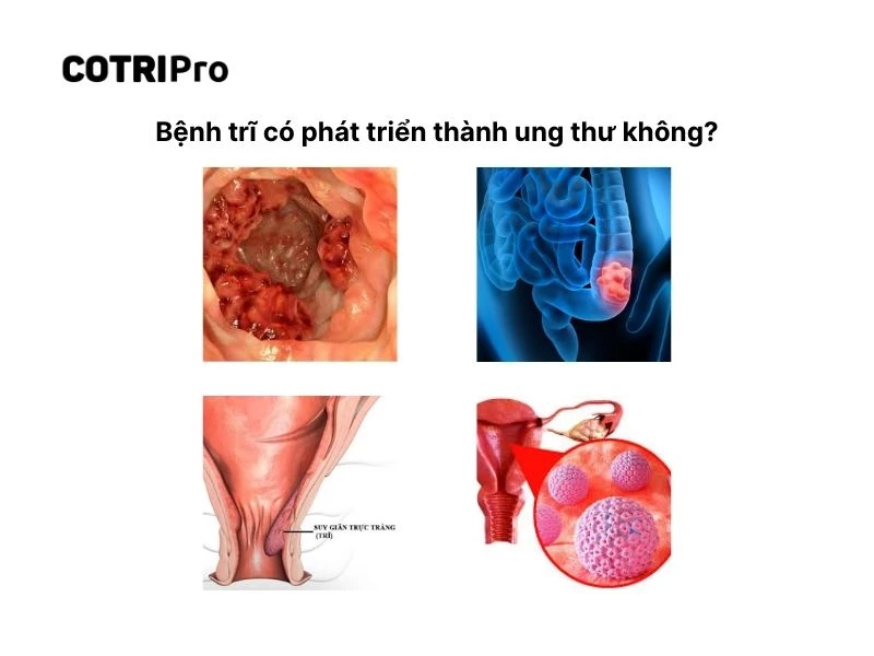 Biến chứng trĩ nguy hiểm