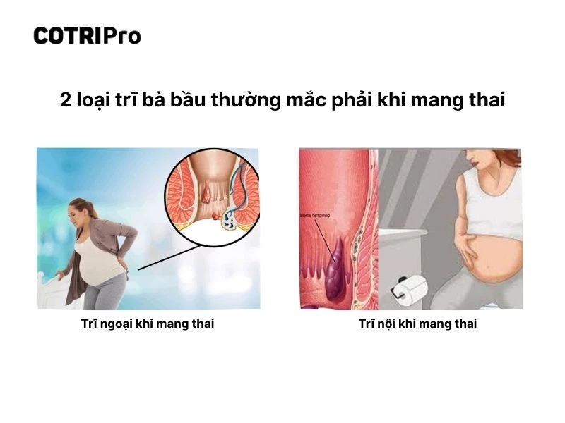 Bà bầu bị trĩ nội và trĩ ngoại