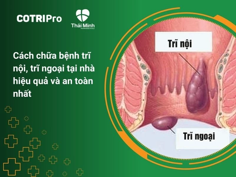 16+ Cách chữa bệnh trĩ nội, trĩ ngoại tại nhà hiệu quả và an toàn nhất
