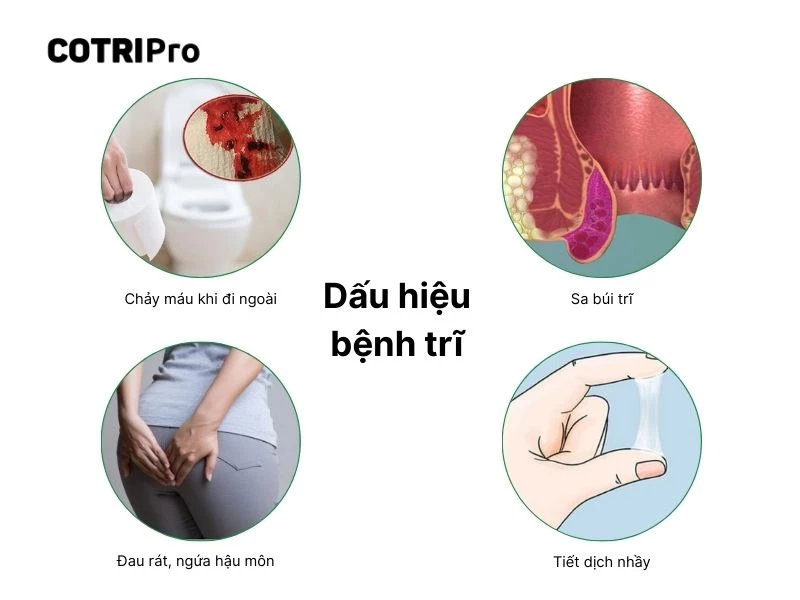 4 dấu hiệu chính của bệnh trĩ.
