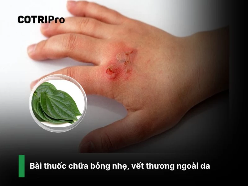 Chữa bỏng nhẹ với lá trầu không