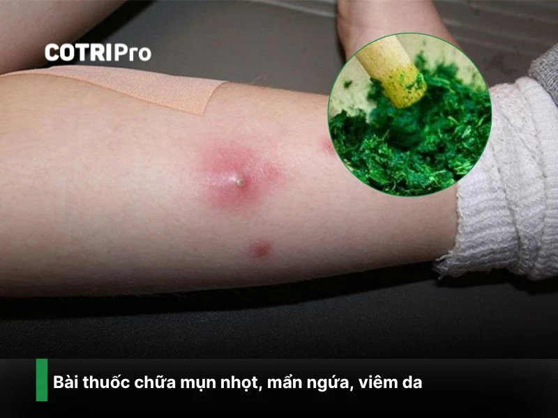 Chữa mụn nhọt với lá trầu không