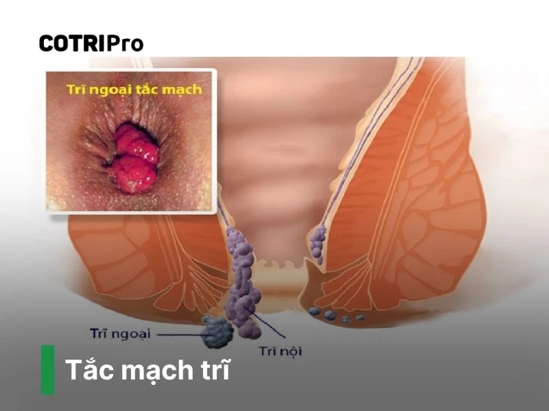 Tắc mạch trĩ nguy hiểm