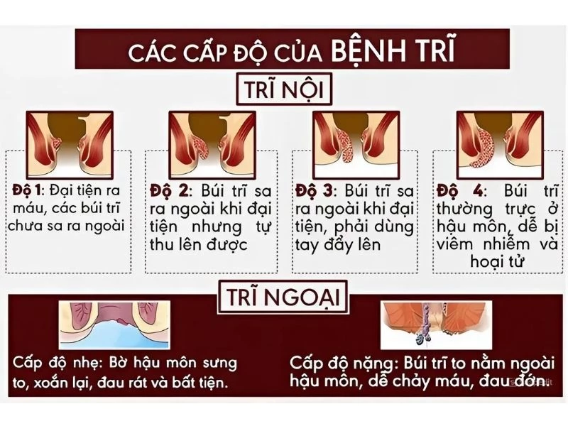 Khác biệt giữa trĩ nội và trĩ ngoại