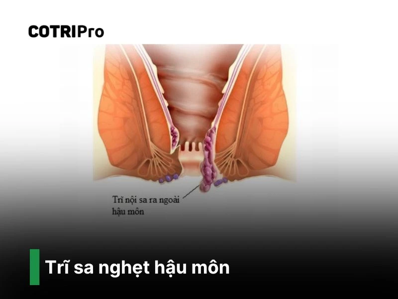 Trĩ sa nghẹt hậu môn nguy hiểm