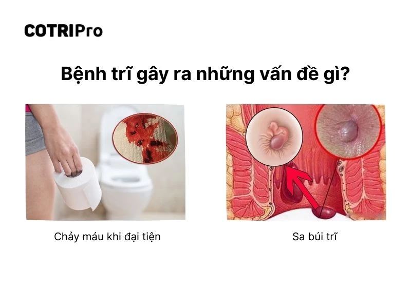 Bệnh trĩ gây chảy máu